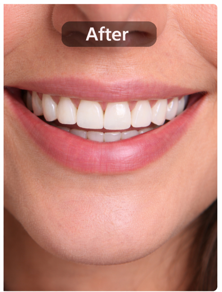 After - Veneers