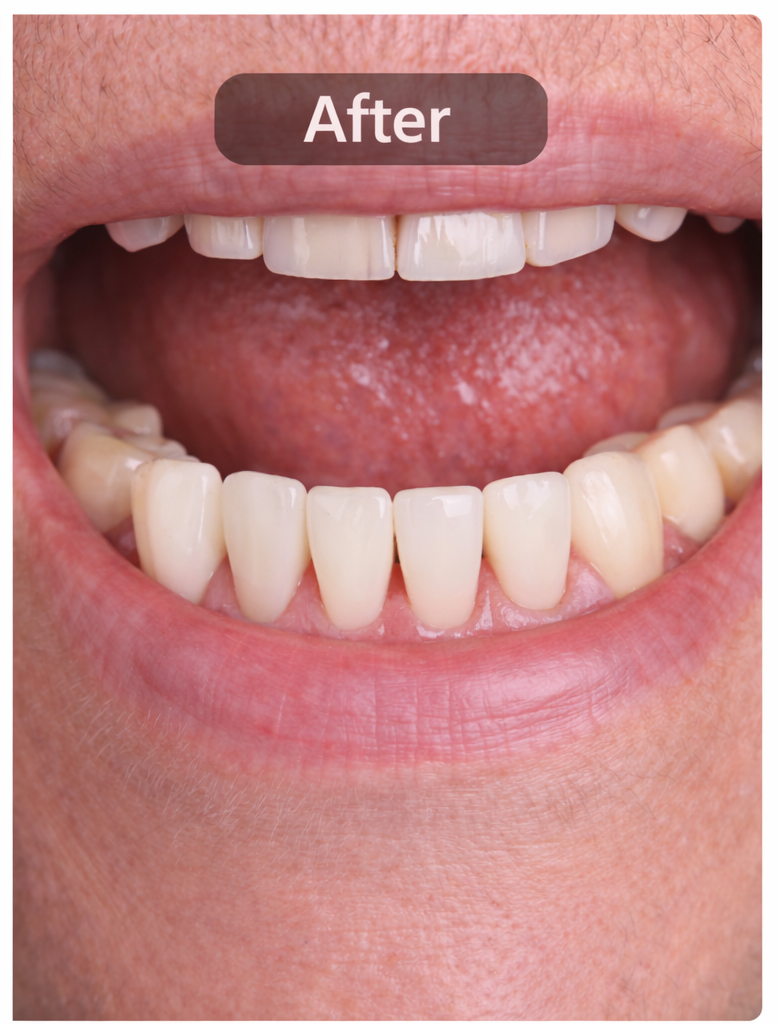 After - Dental Implants