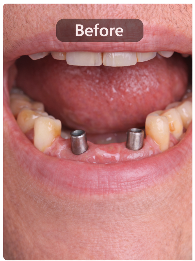 Before - Dental Implants